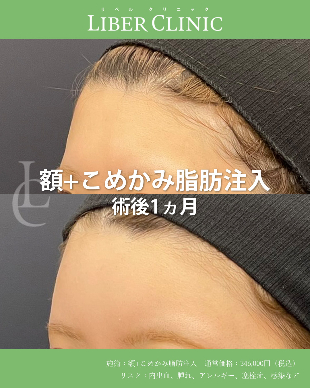 手術前と術後1ヵ月