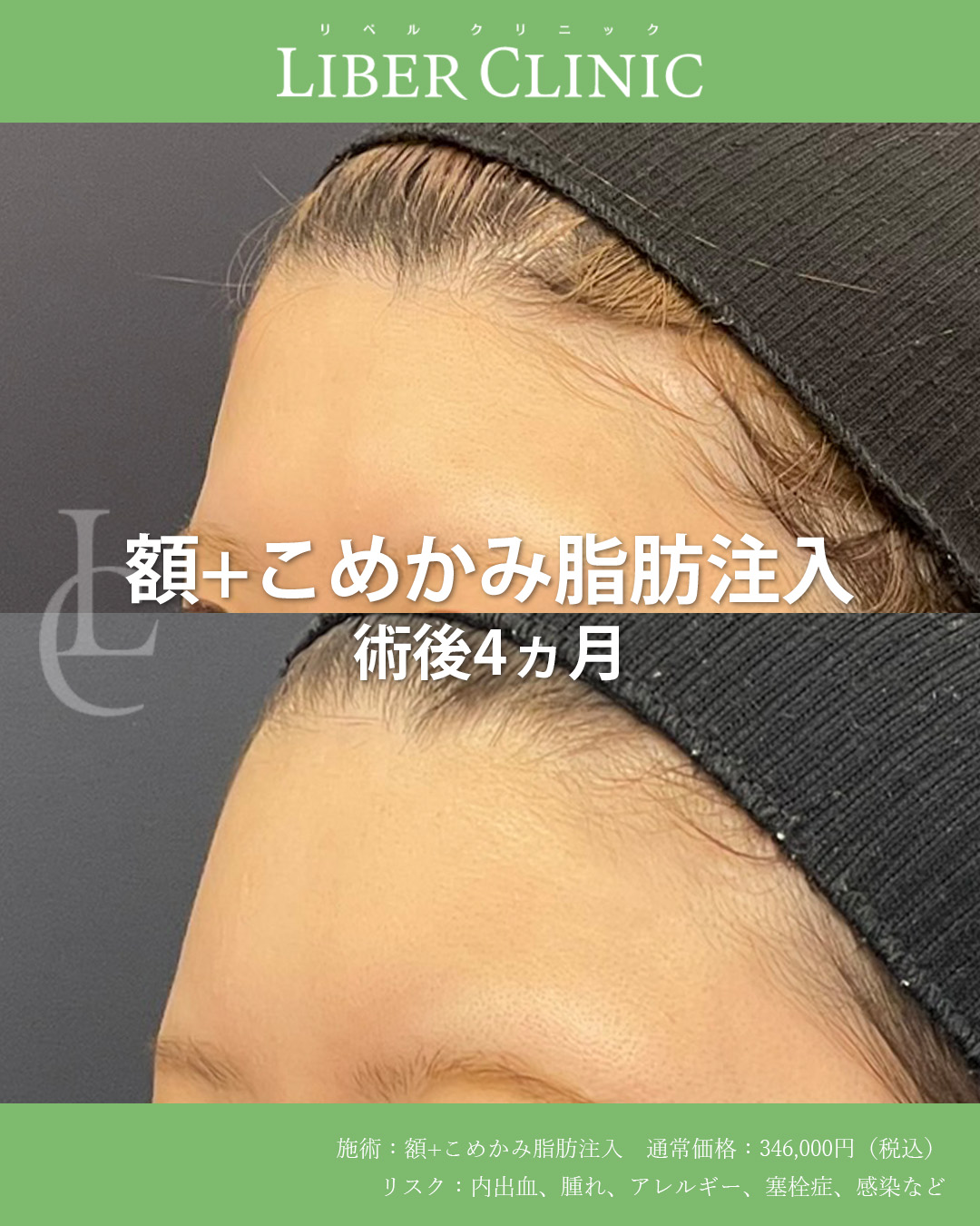 手術前と術後4ヵ月