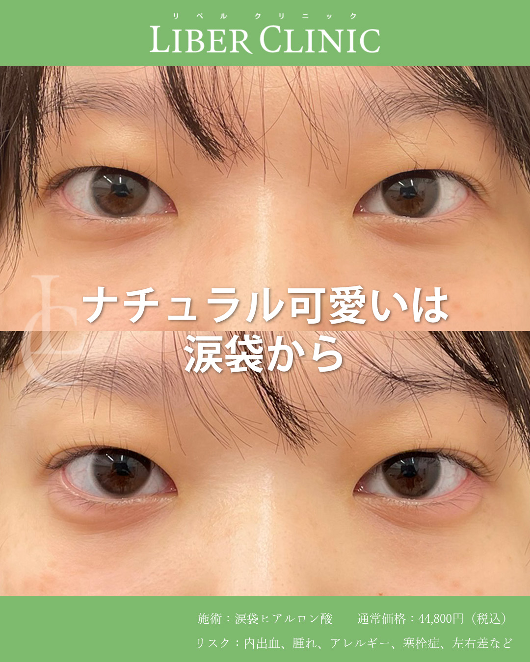 ナチュラル可愛いは涙袋から