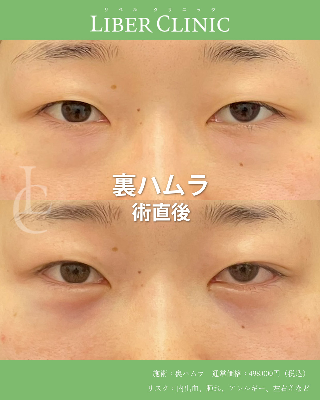 手術前と術直後