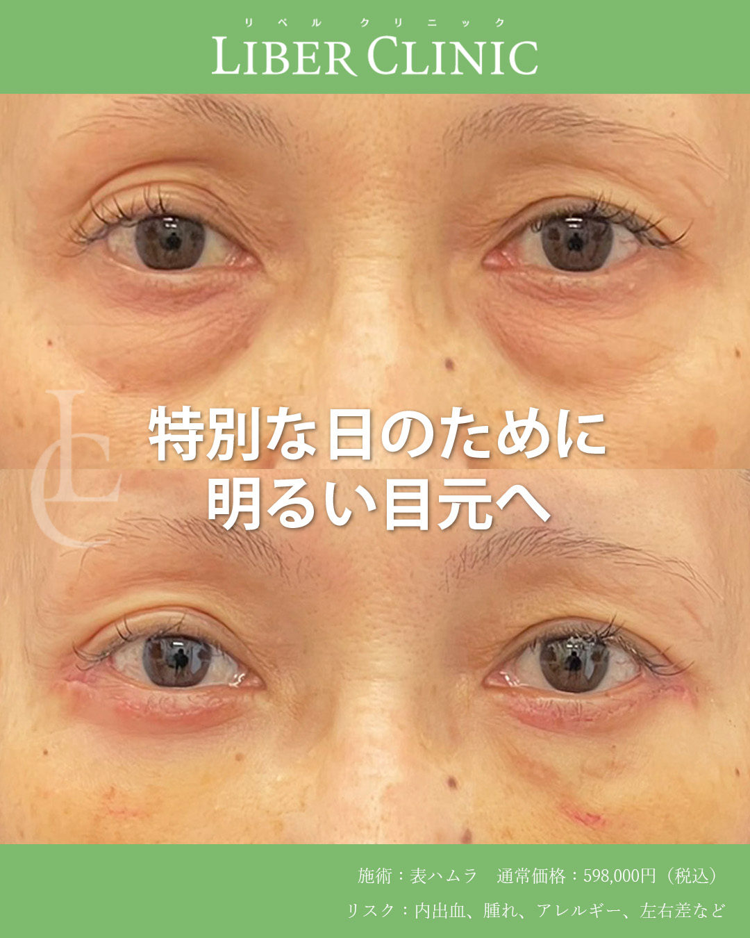 特別な日のために表ハムラで明るい目元へ