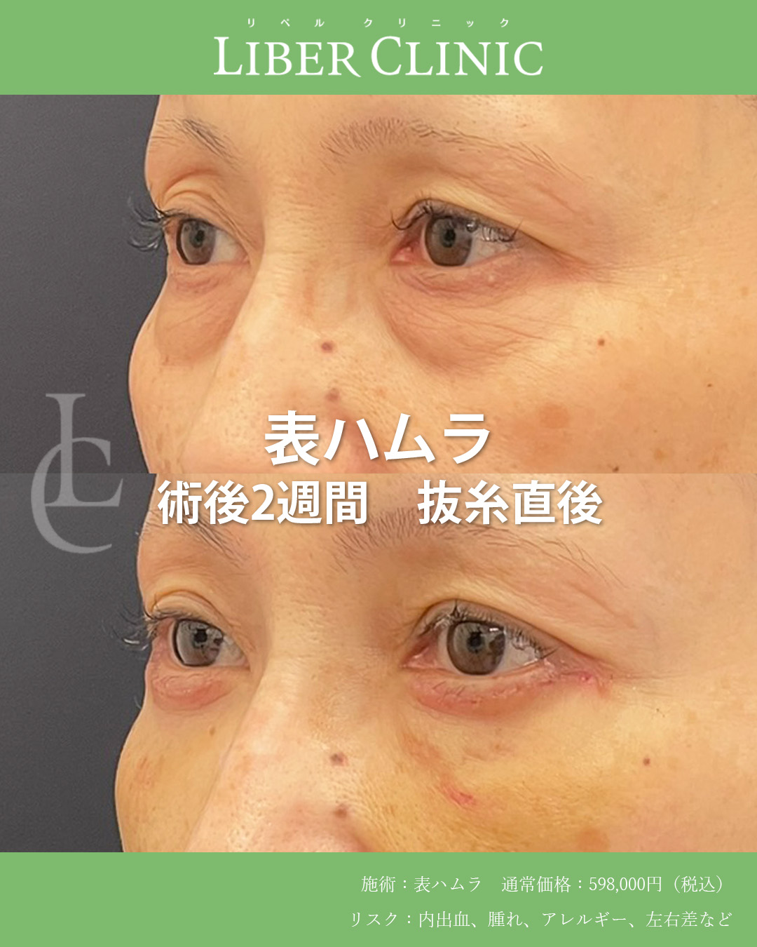 手術前と術後2週間