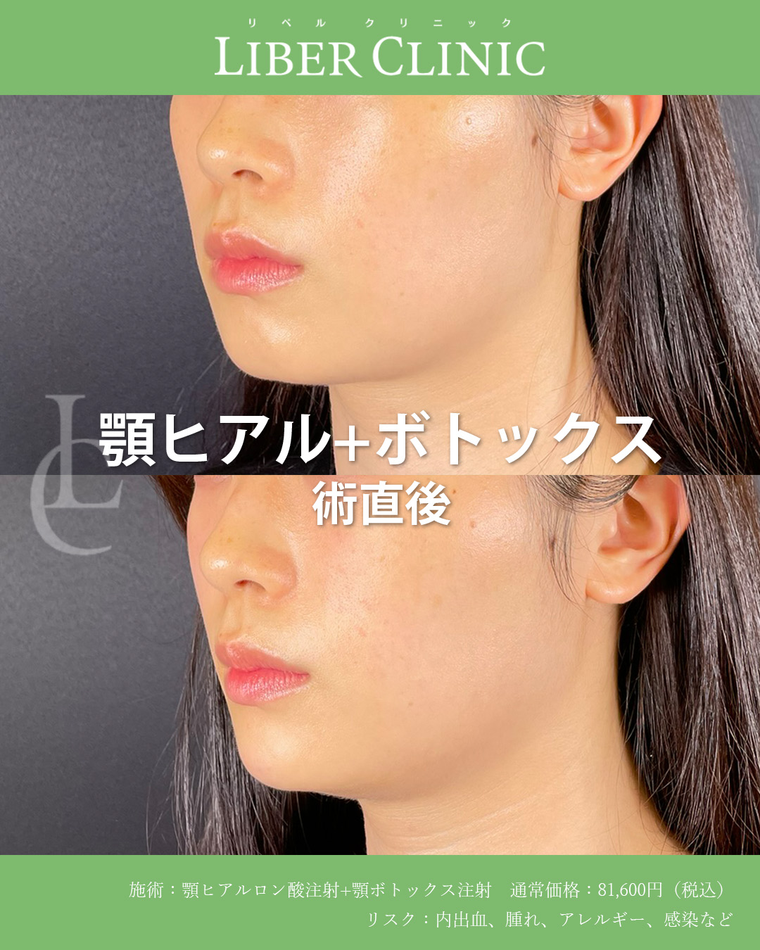 手術前と術直後