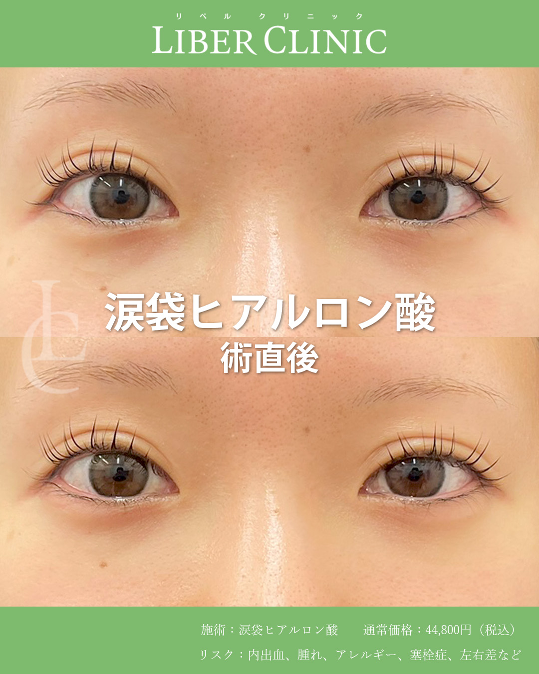 やりすぎ感のないナチュラル涙袋