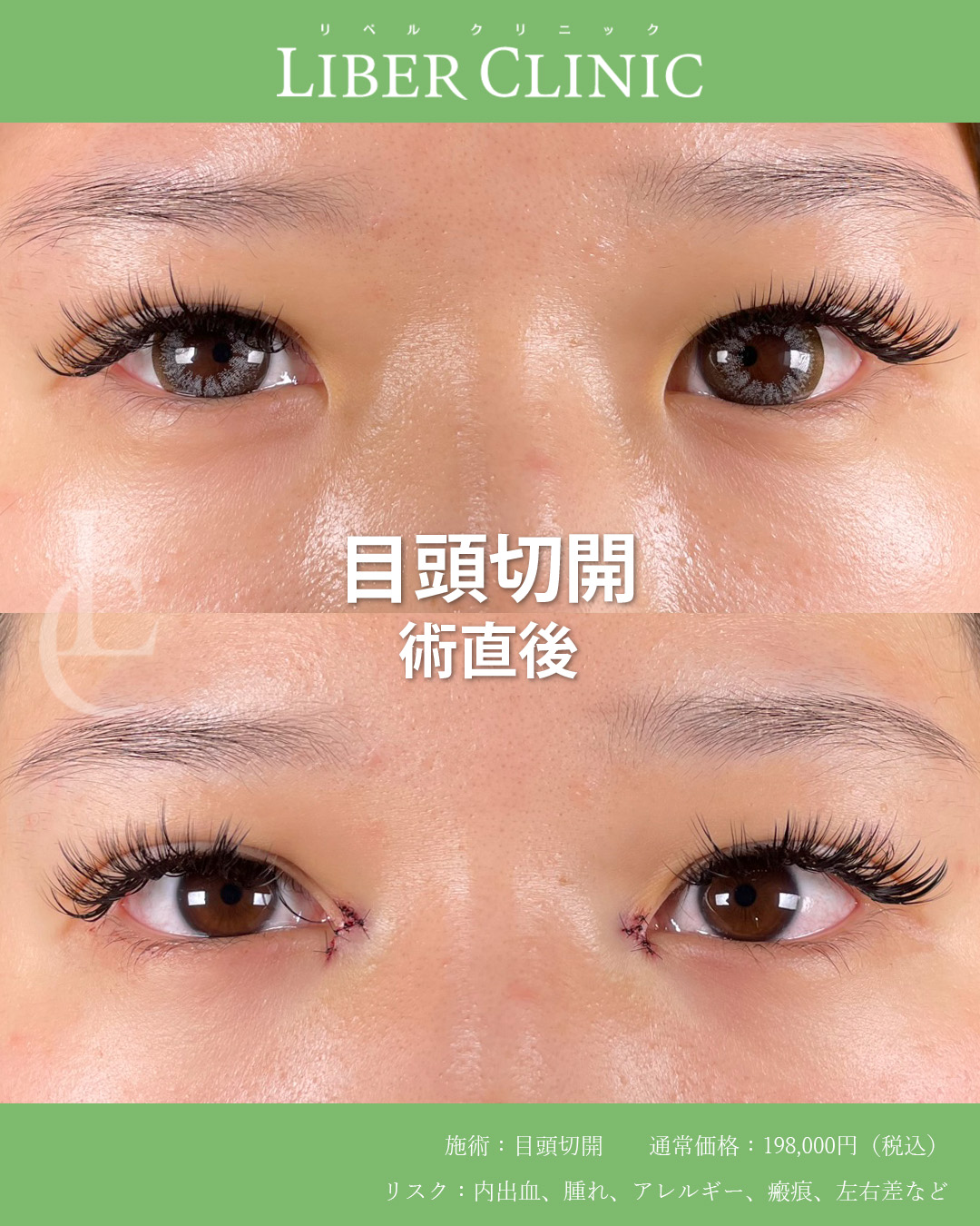 手術前と術直後