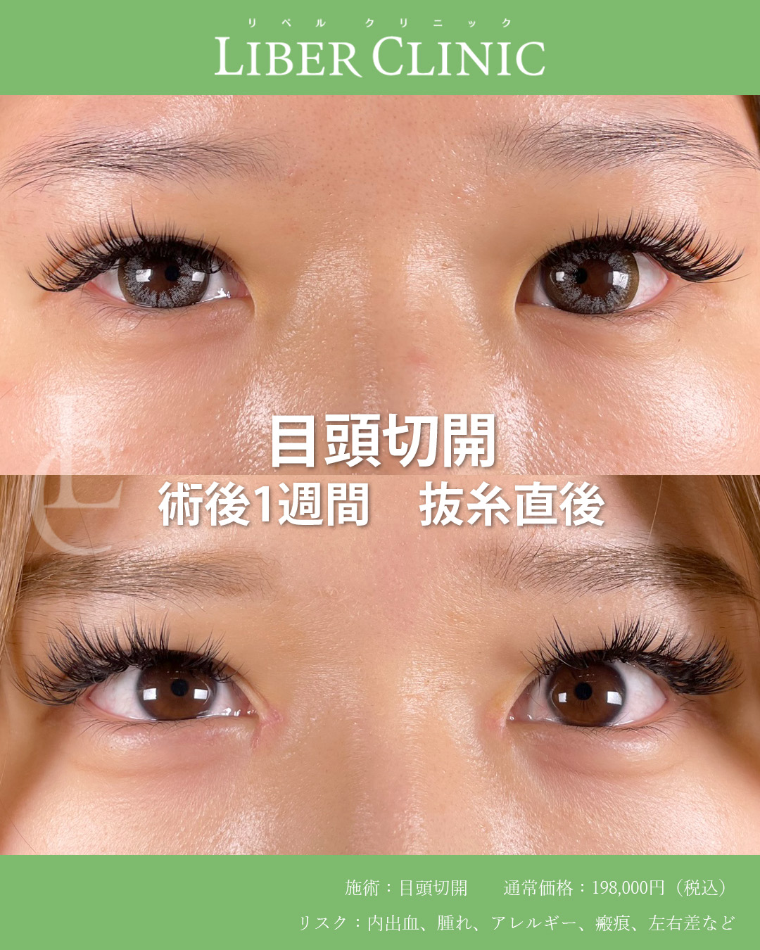 手術前と術後1週間抜糸直後