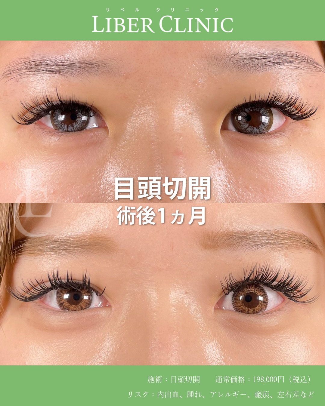 手術前と術後1ヵ月