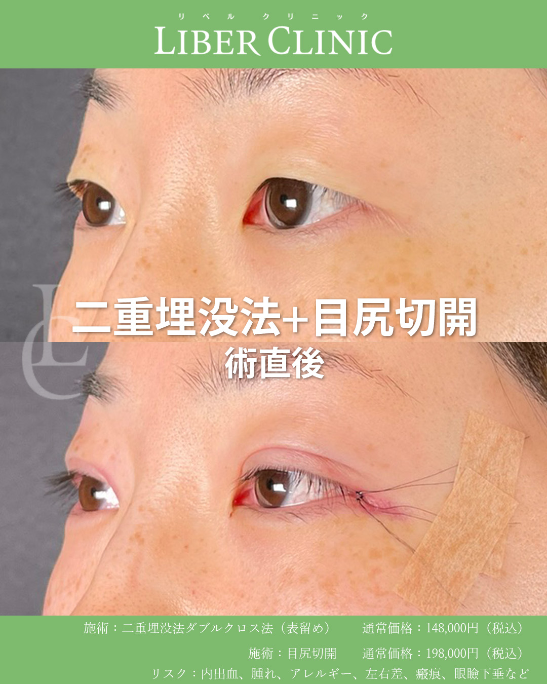 手術前と術直後