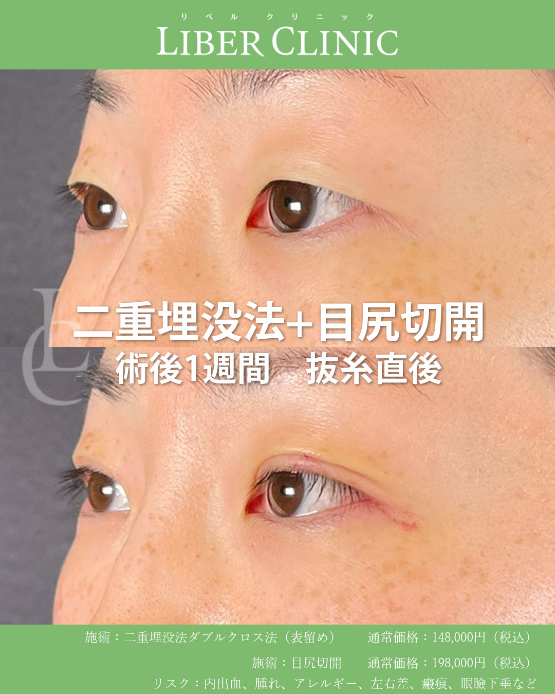 手術前と術後1週間 抜糸直後