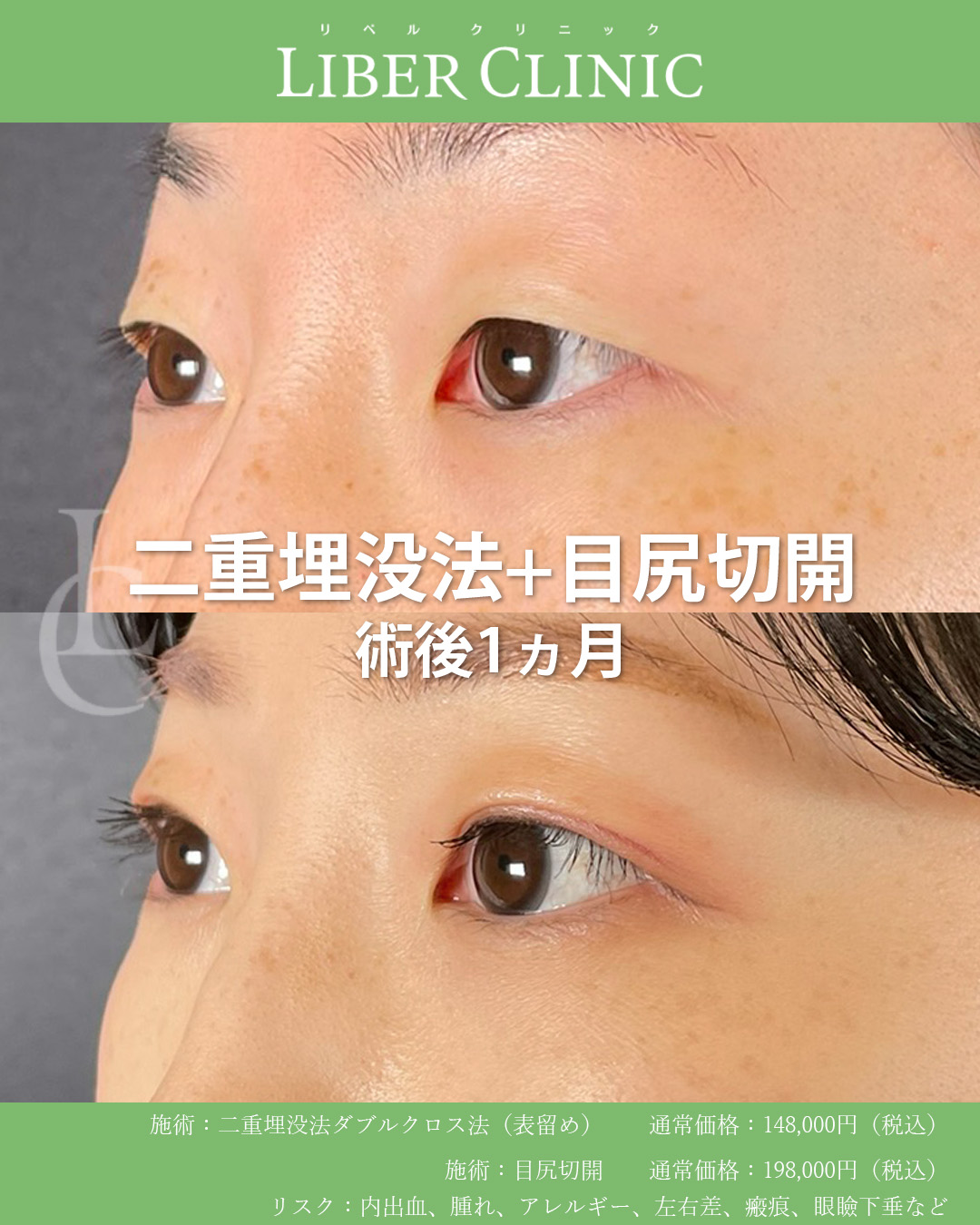 手術前と術後1ヵ月