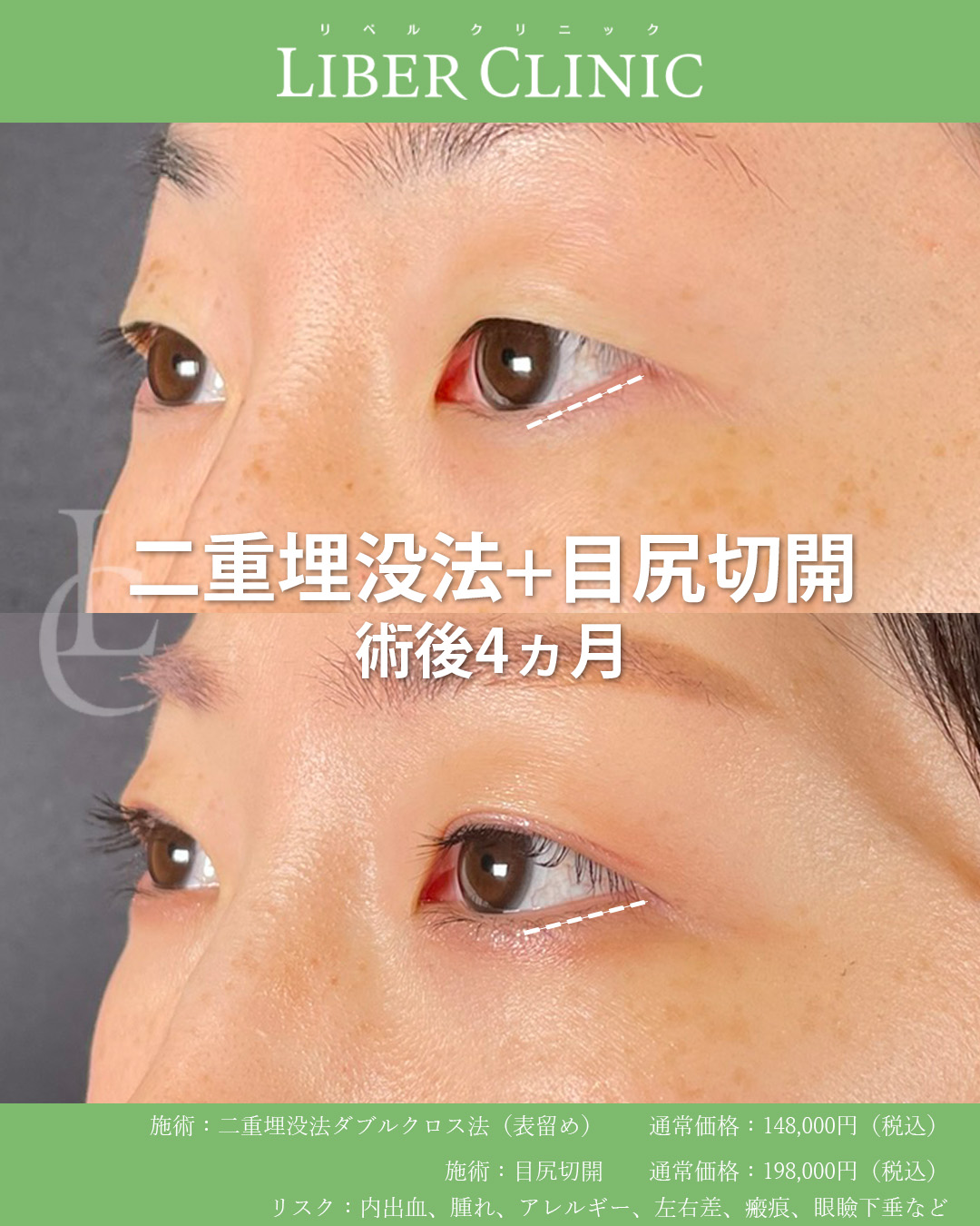 自然なのに印象変わる、二重埋没法と目尻切開