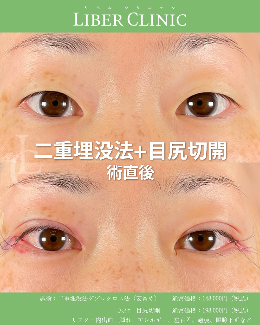 手術前と術直後