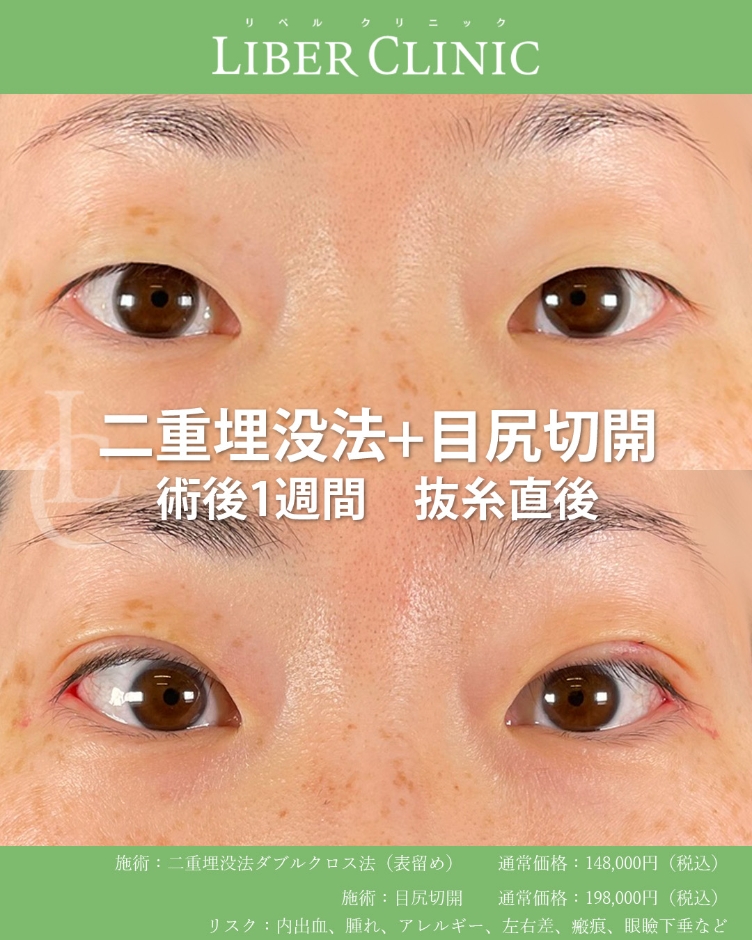 手術前と術後1週間 抜糸直後