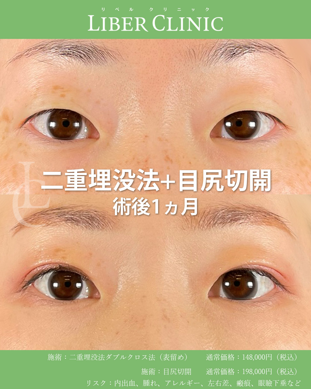 手術前と術後1ヵ月