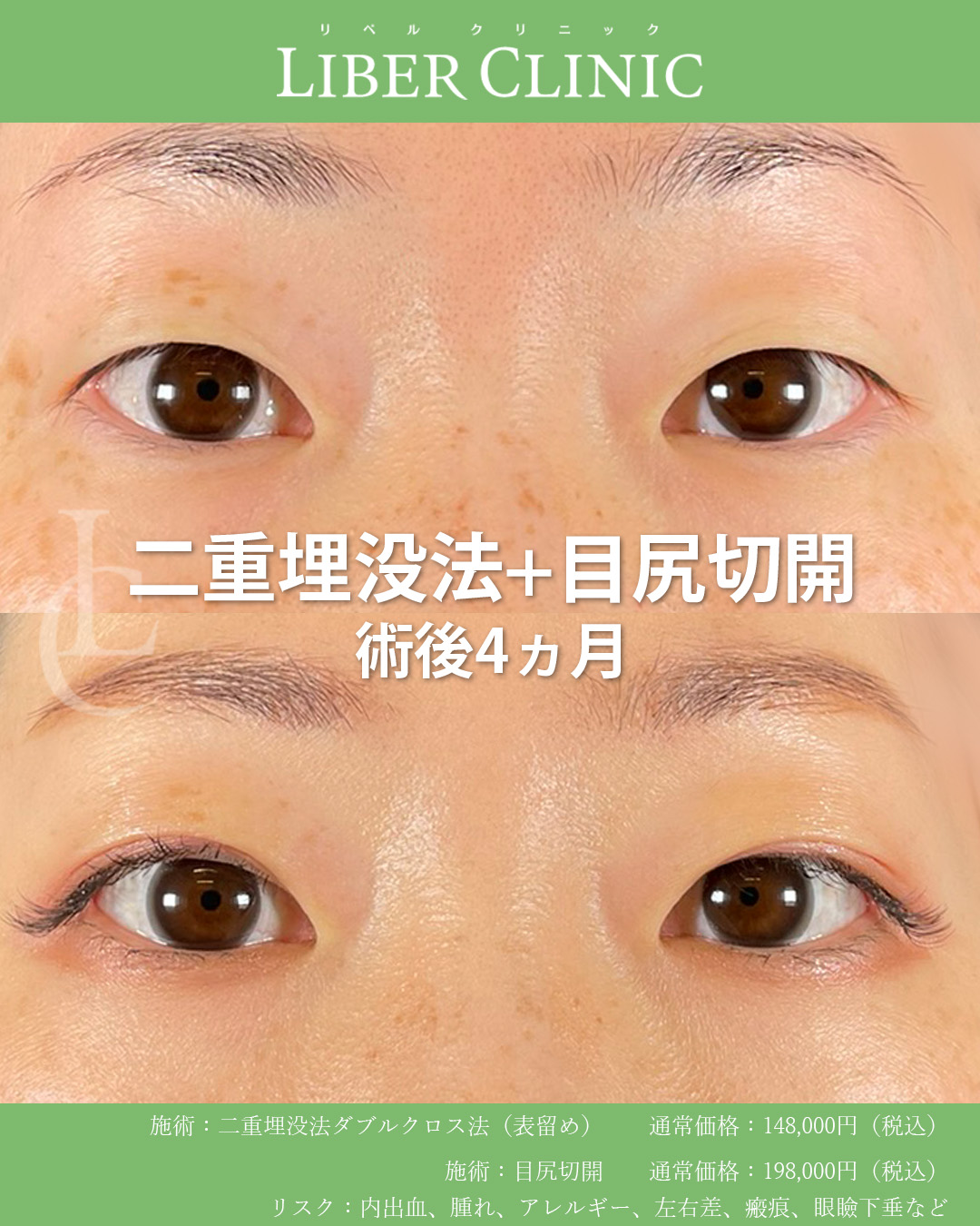 手術前と術後4ヵ月