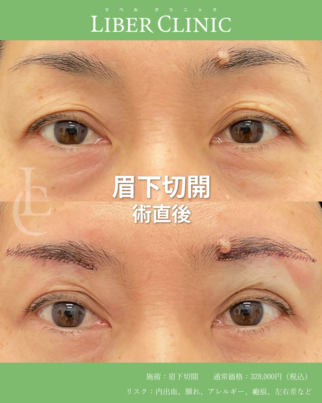 手術前と術直後