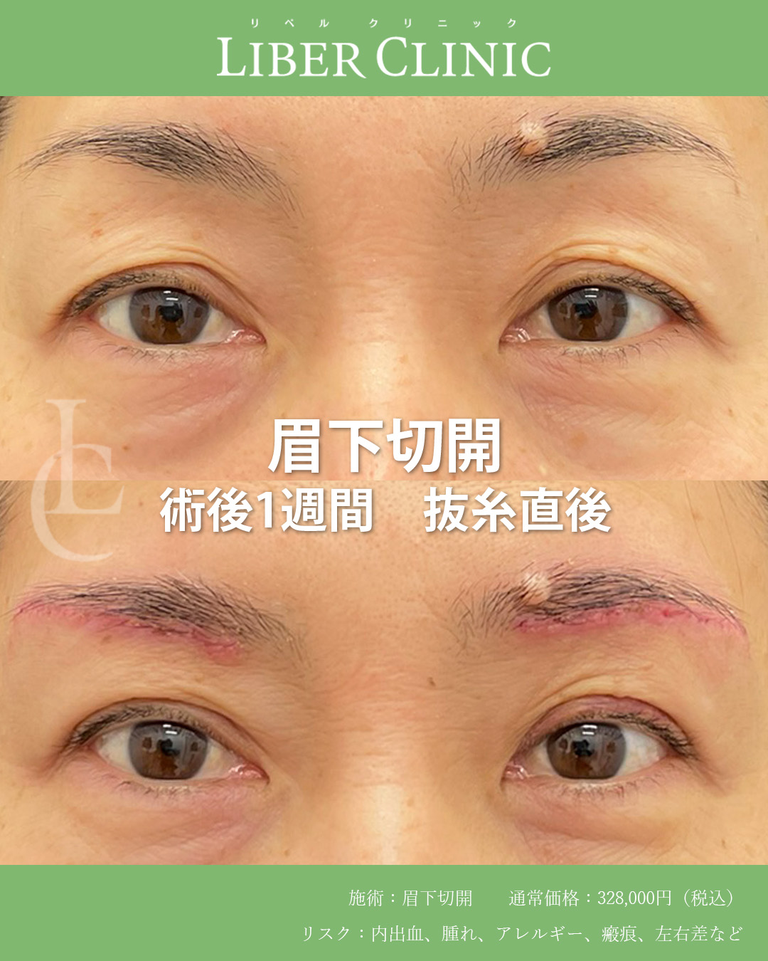 手術前と術後1週間 抜糸直後