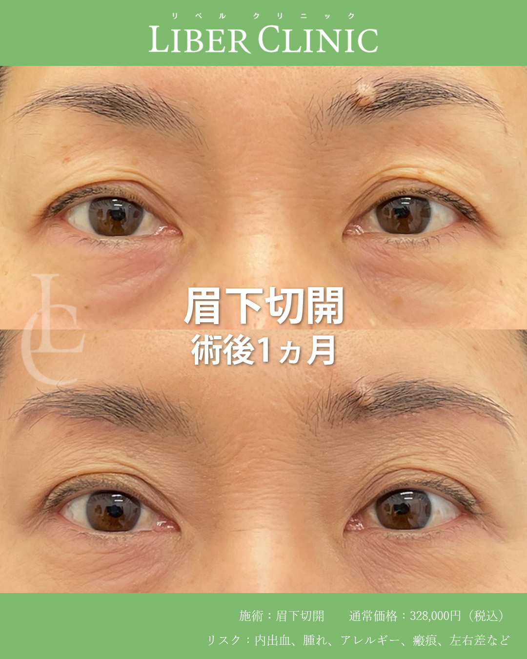 手術前と術後1ヵ月