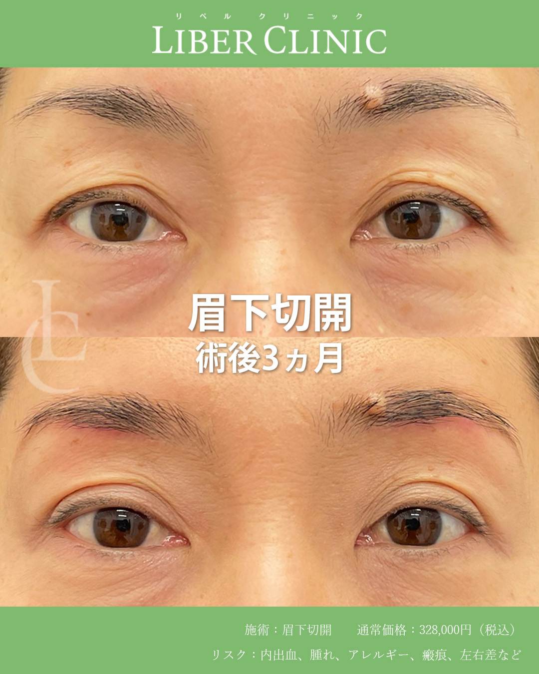 50代からの上まぶたナチュラルリフト