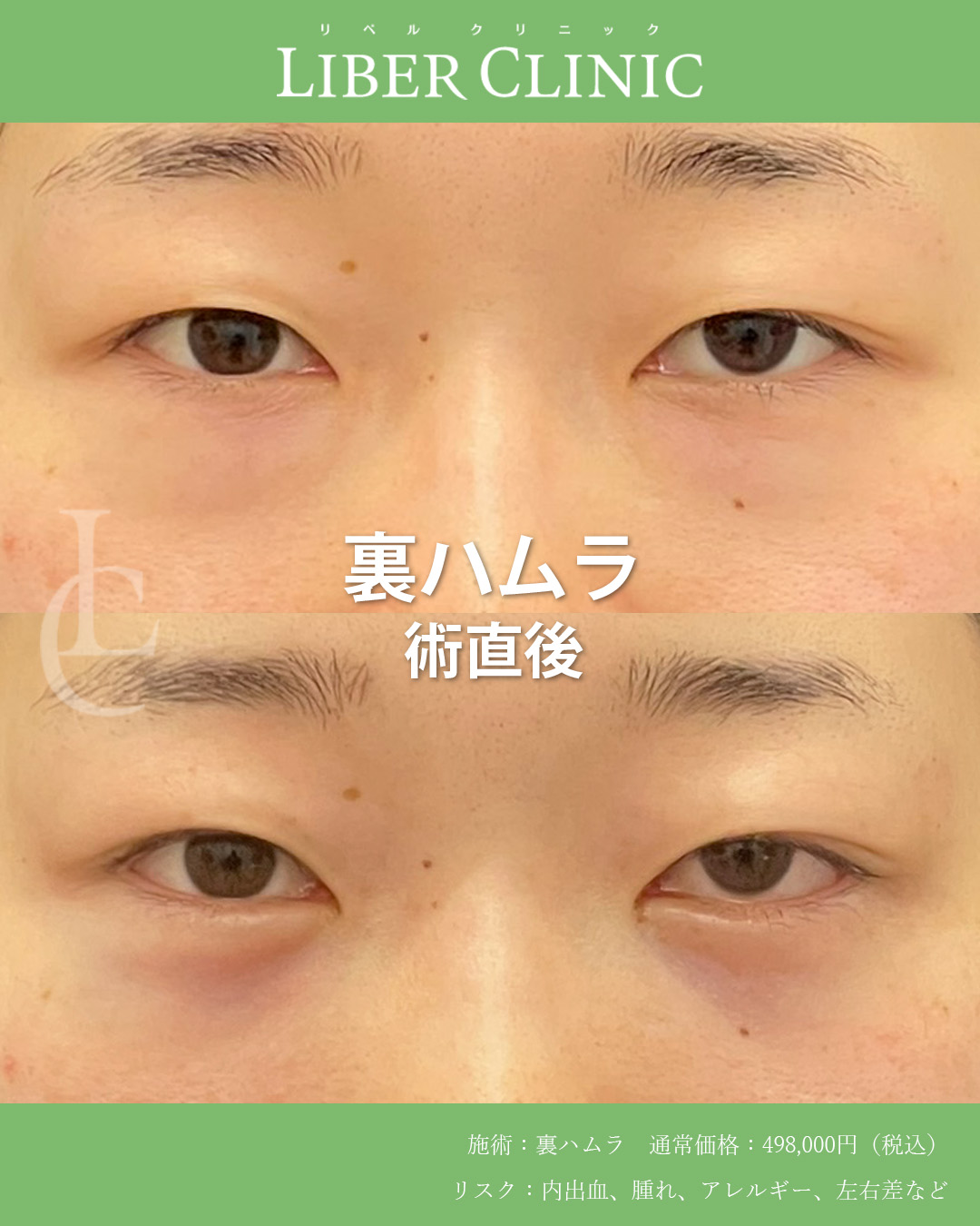 手術前と術直後