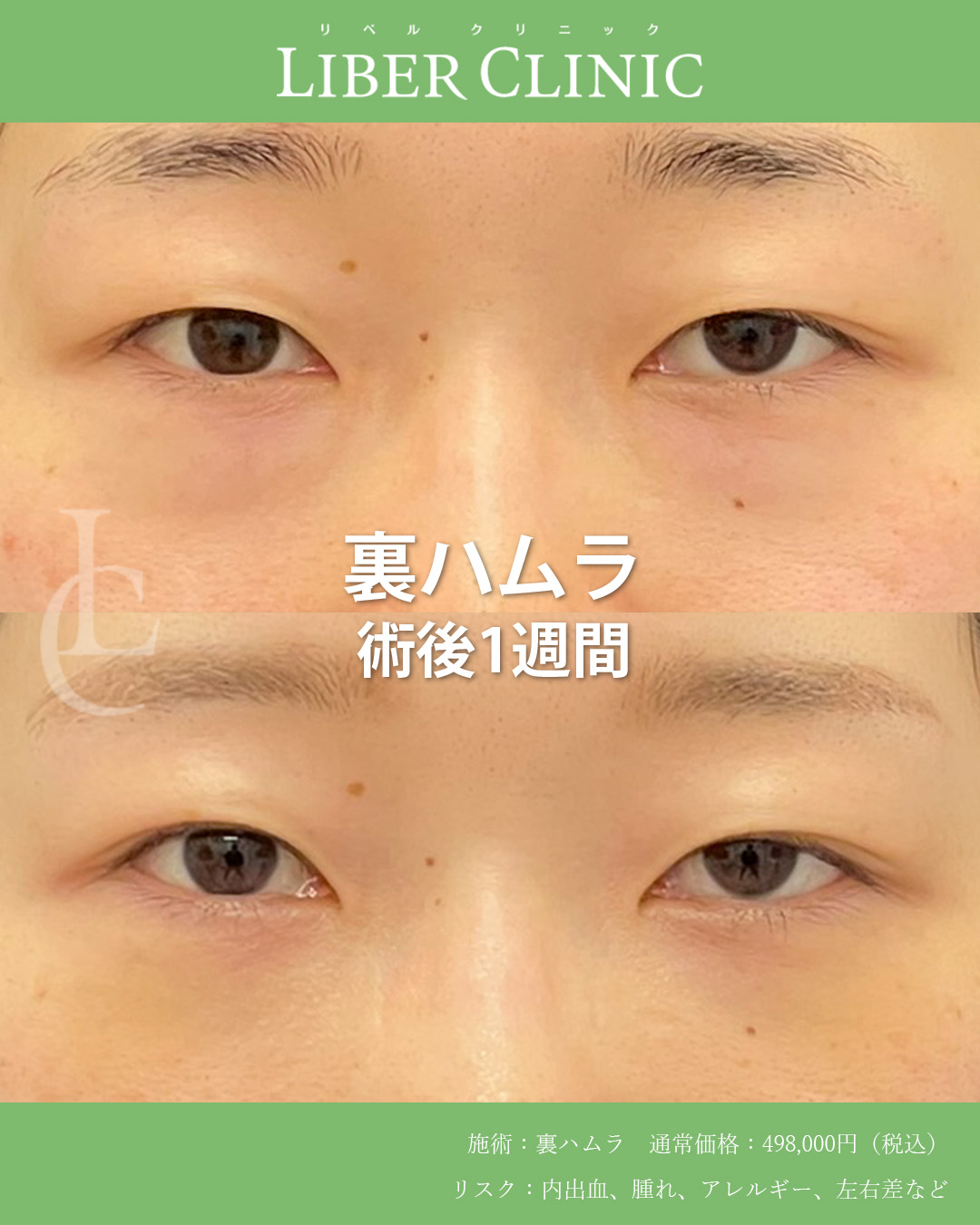 手術前と術後1週間