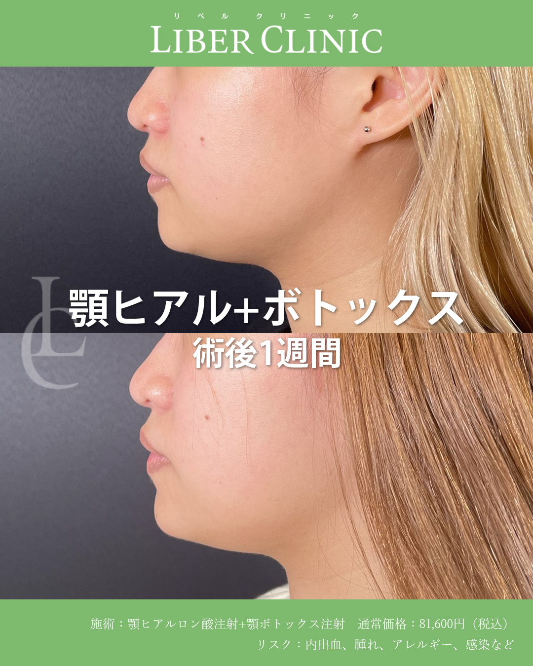 顎先を整えて横顔も美しく