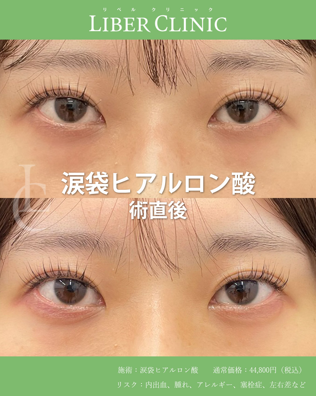 涙袋でつくるさりげない可愛さ