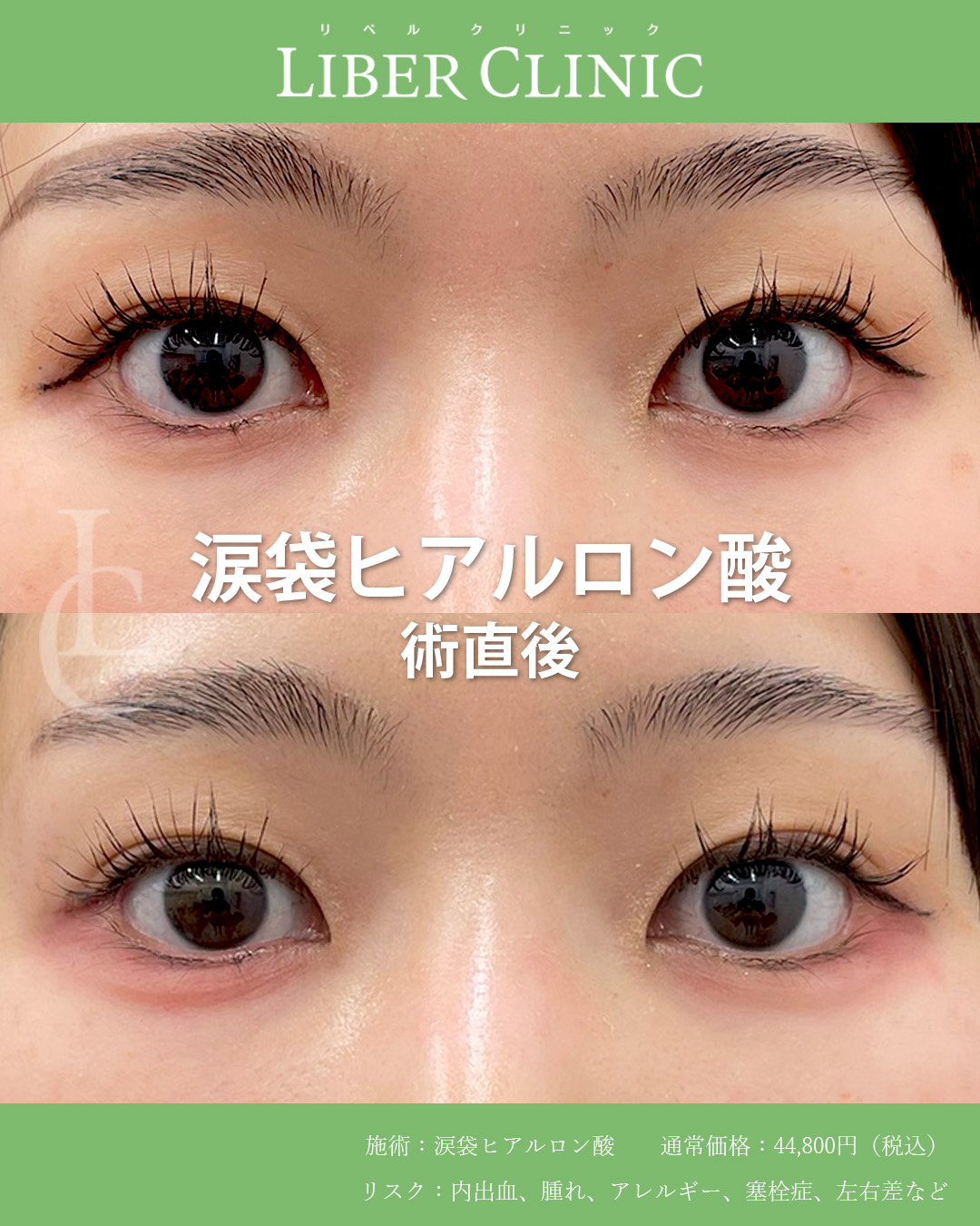 ナチュラル派に選ばれる涙袋ヒアルロン酸