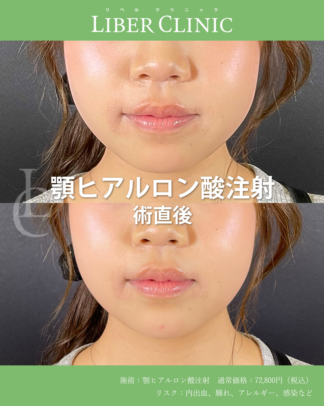 手術前と術直後
