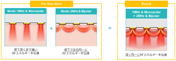 モノポーラとバイポーラの2種類のRF（高周波）