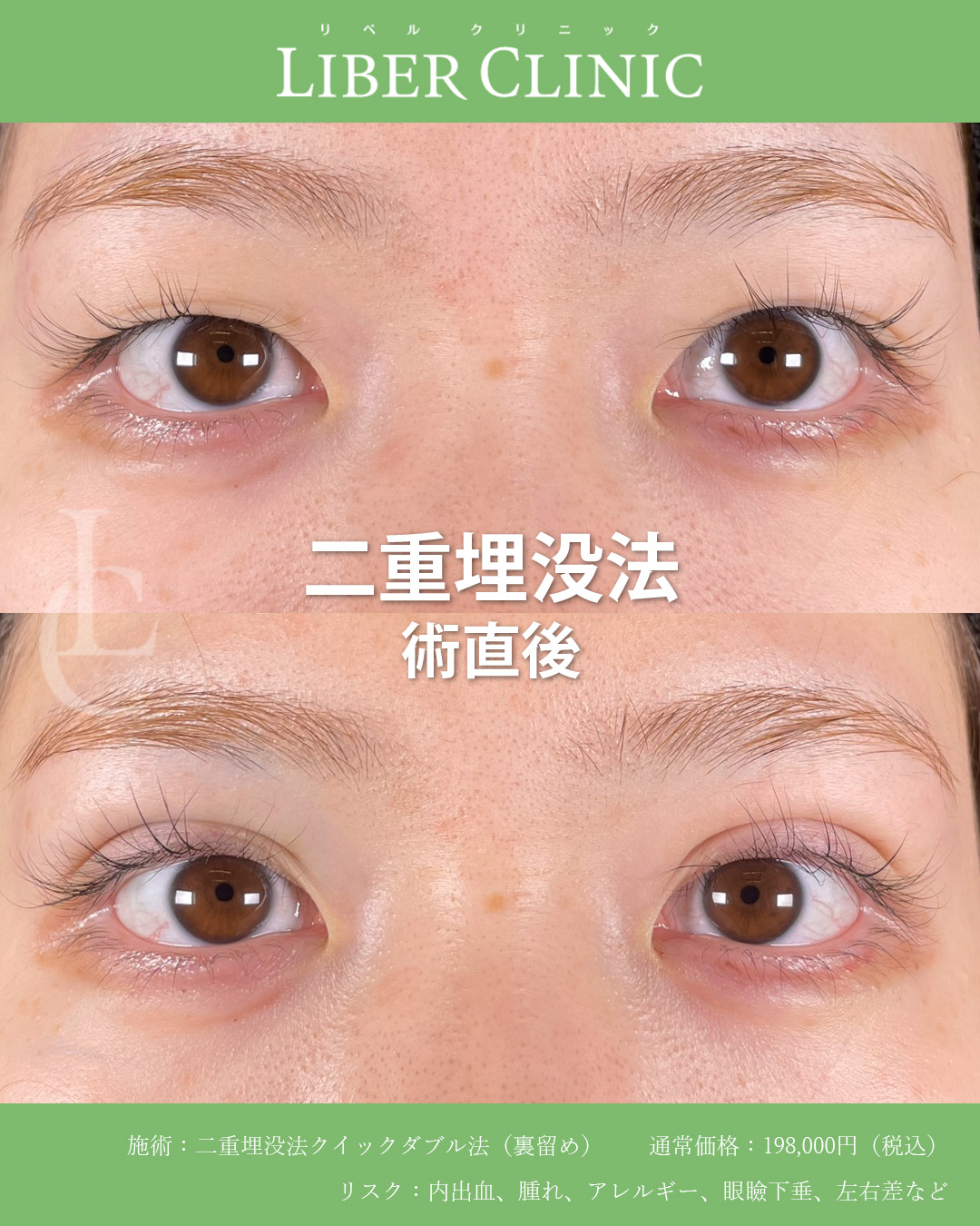 手術前と術直後