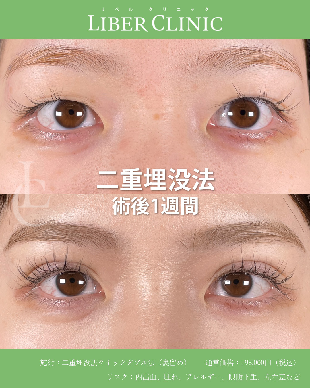 手術前と術後1週間