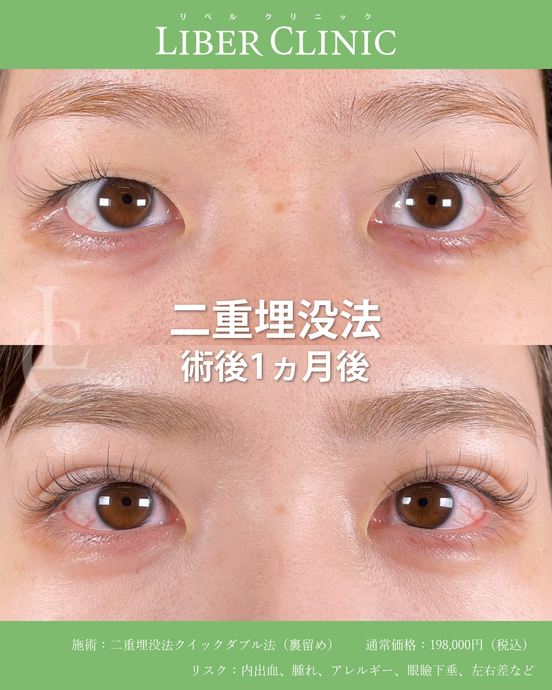 左右差を考慮した自然で美しい二重へ