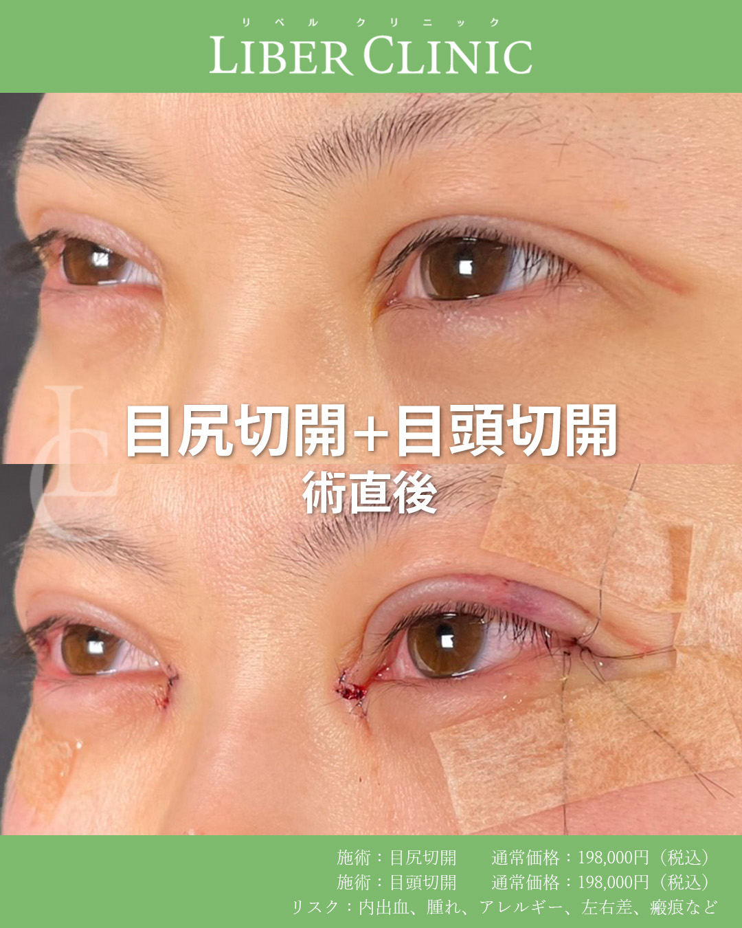 手術前と術直後