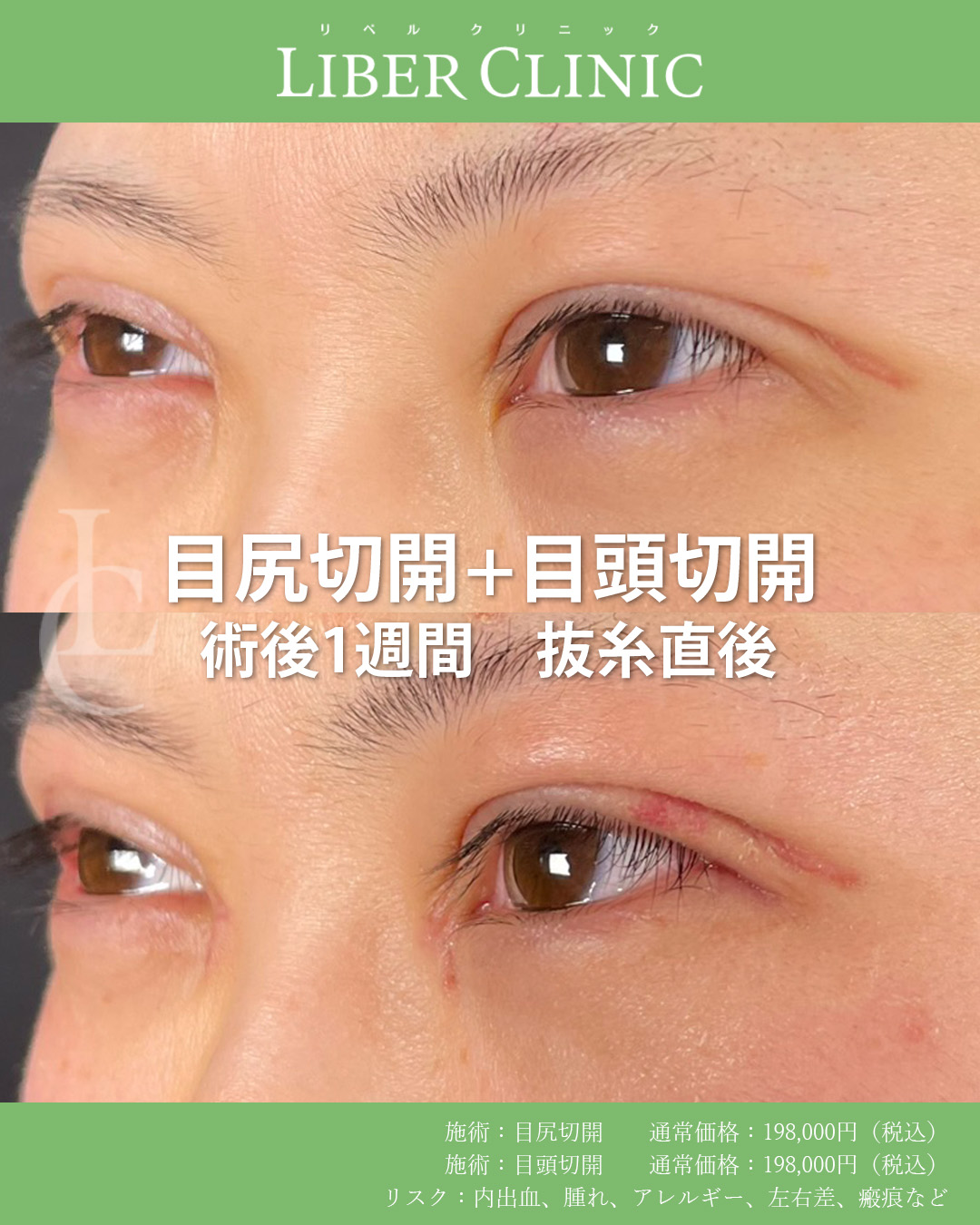 手術前と術後1週間抜糸直後