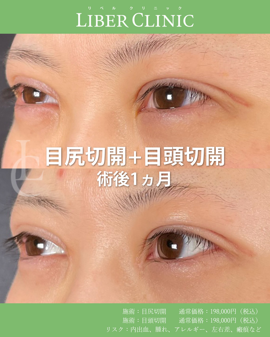 手術前と術後1ヵ月