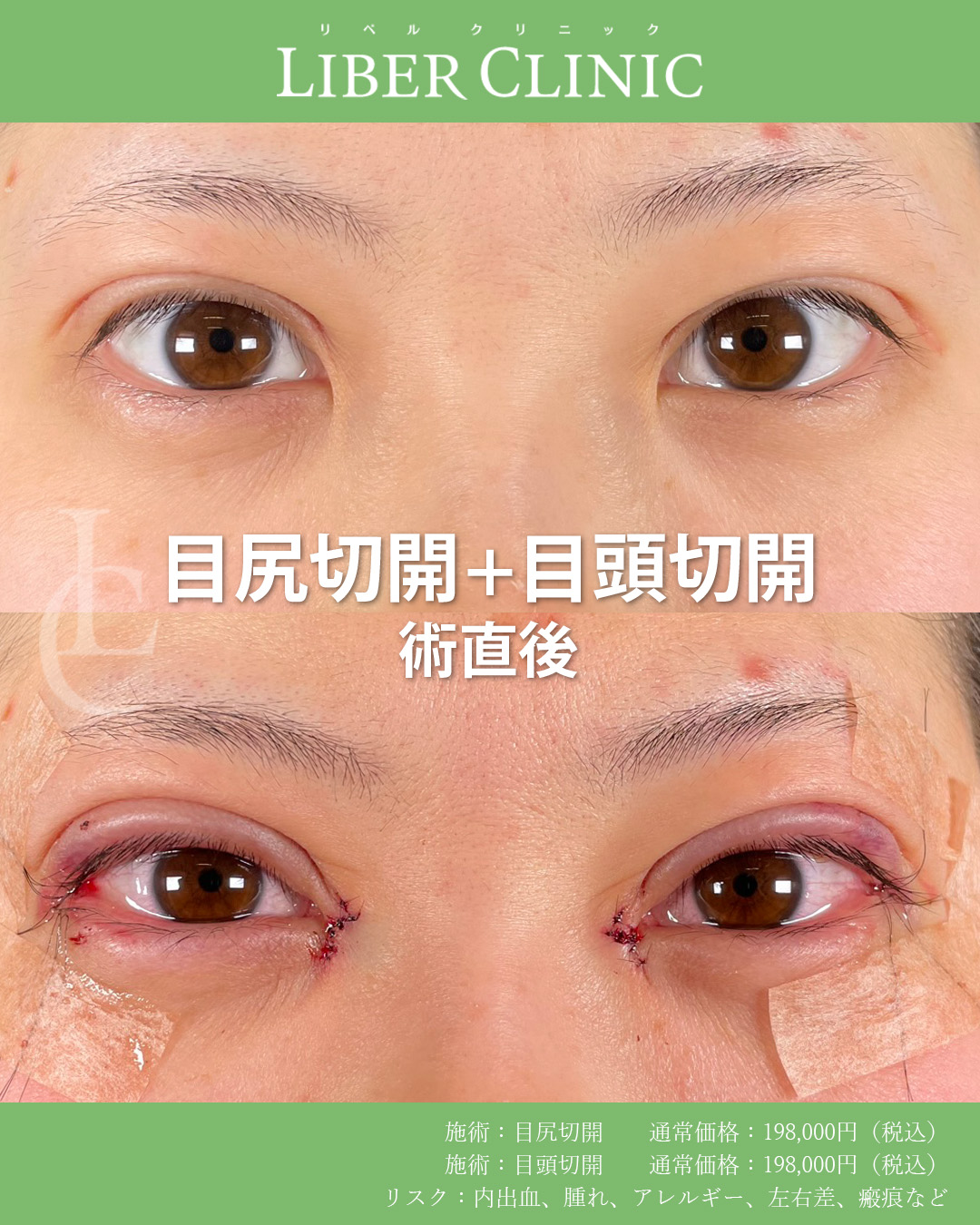 手術前と術直後