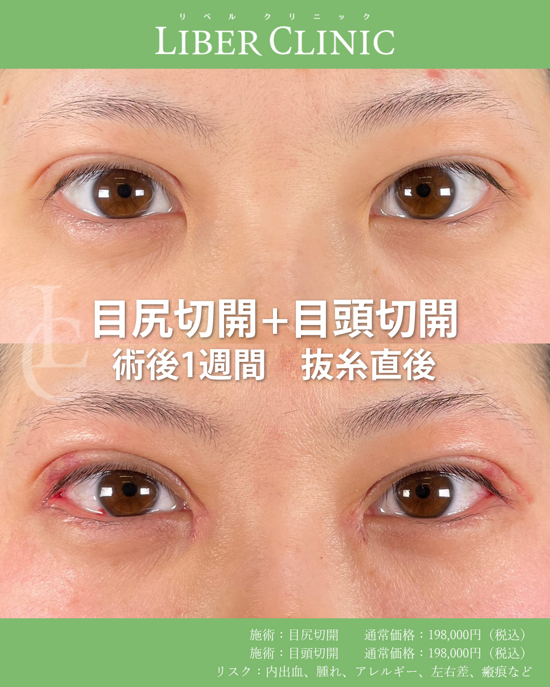 手術前と術後1週間抜糸直後