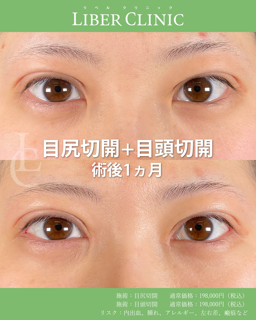 開きにくさを解消する目尻切開