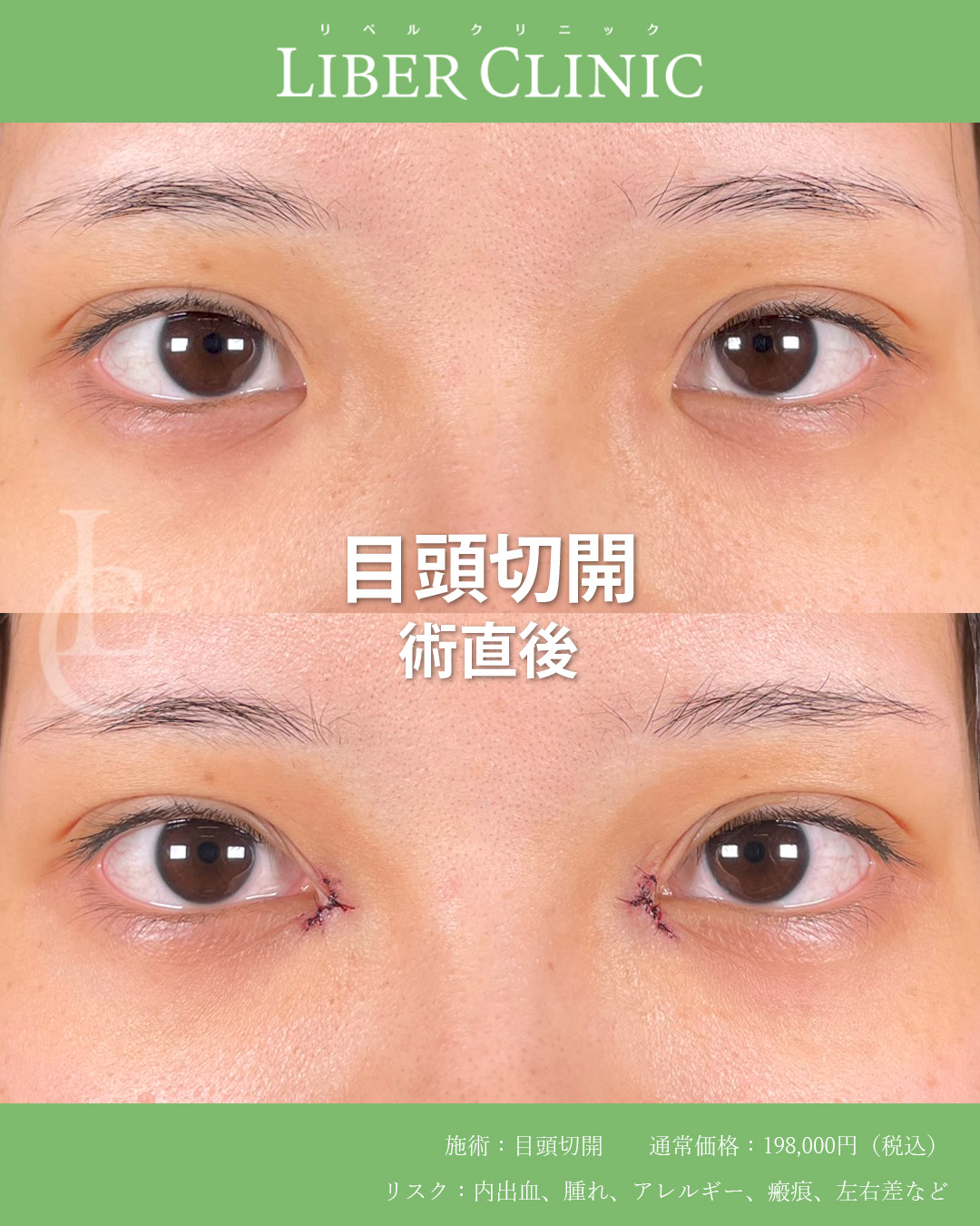 手術前と術直後