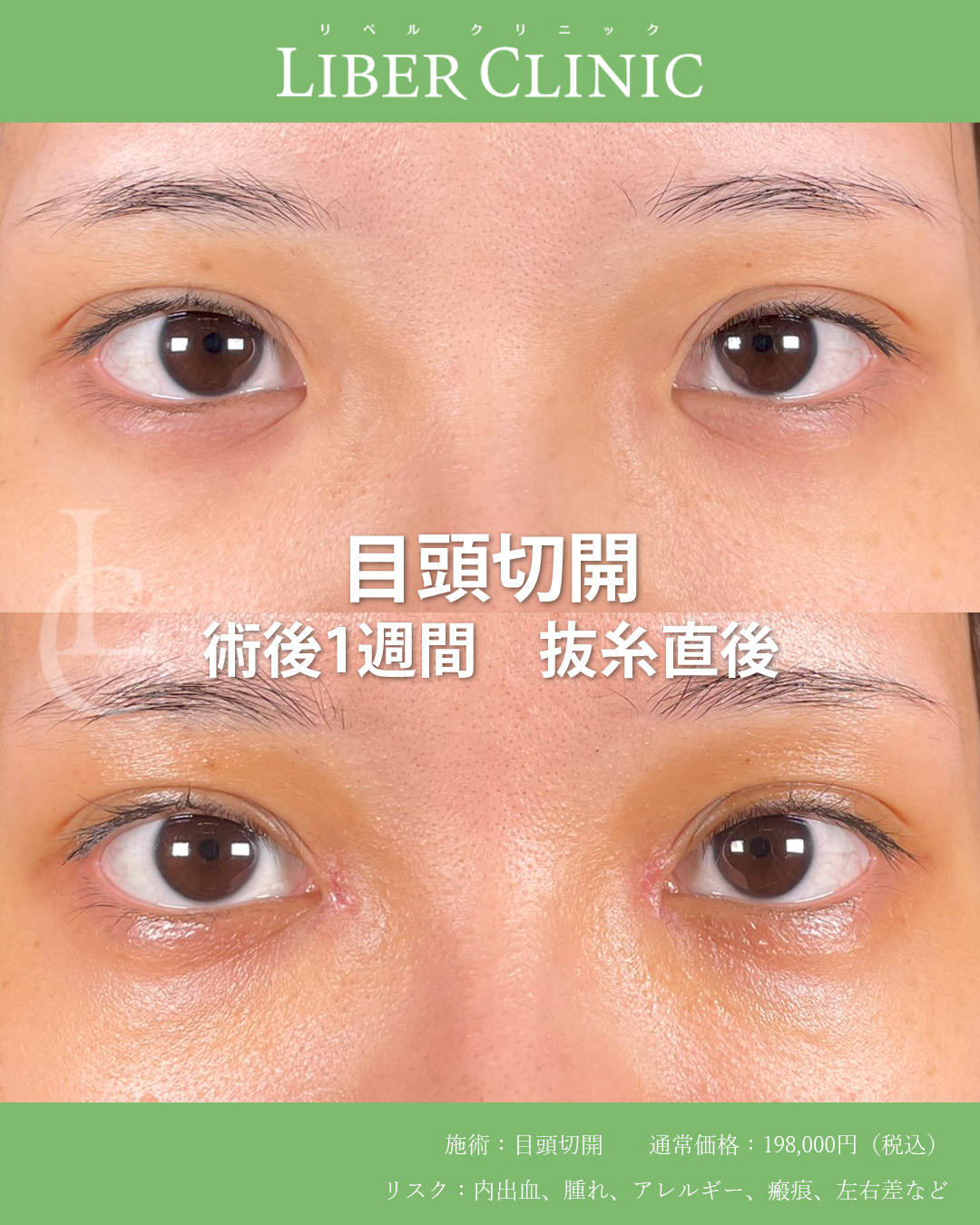 手術前と術後1週間抜糸直後