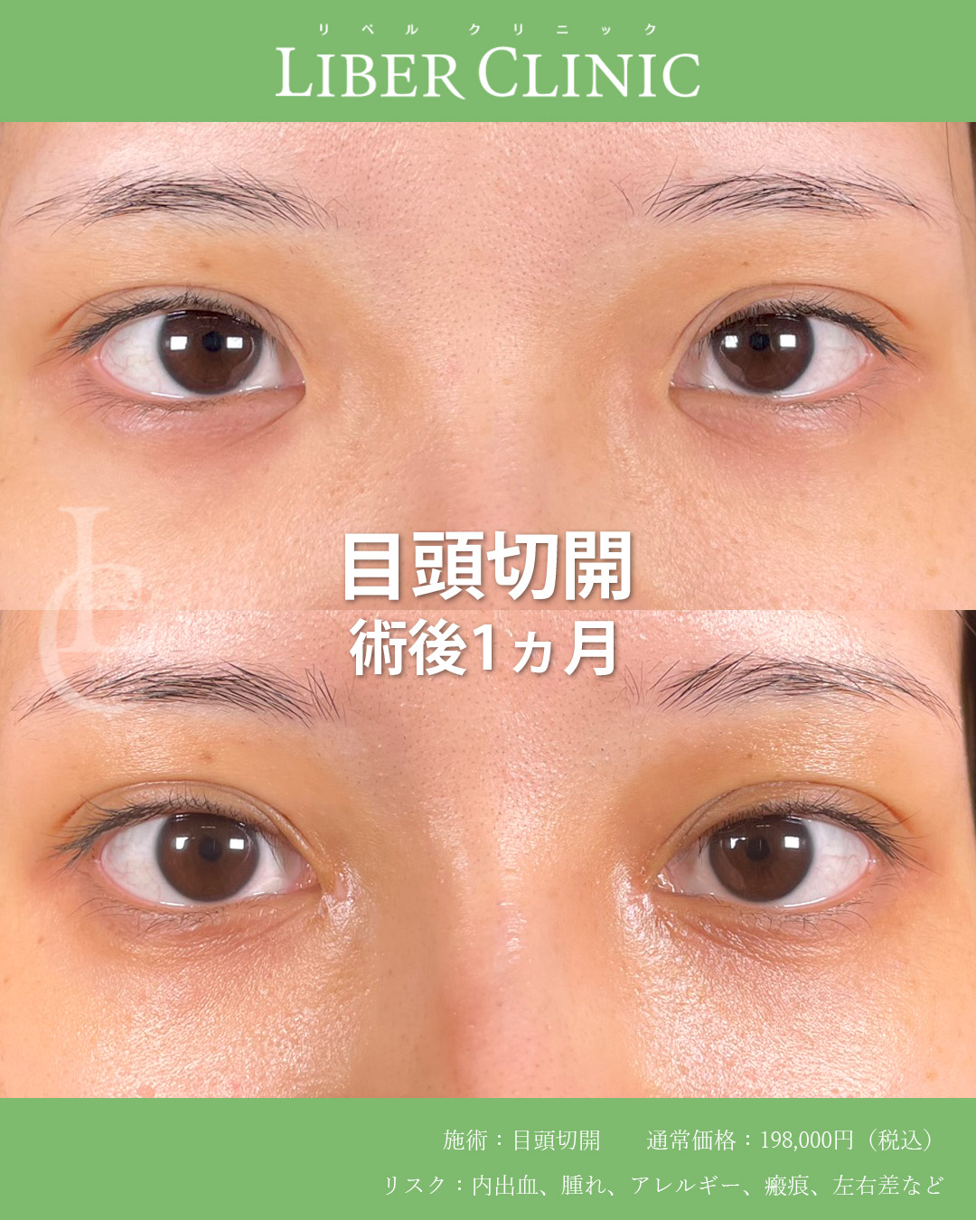 手術前と術後1ヵ月