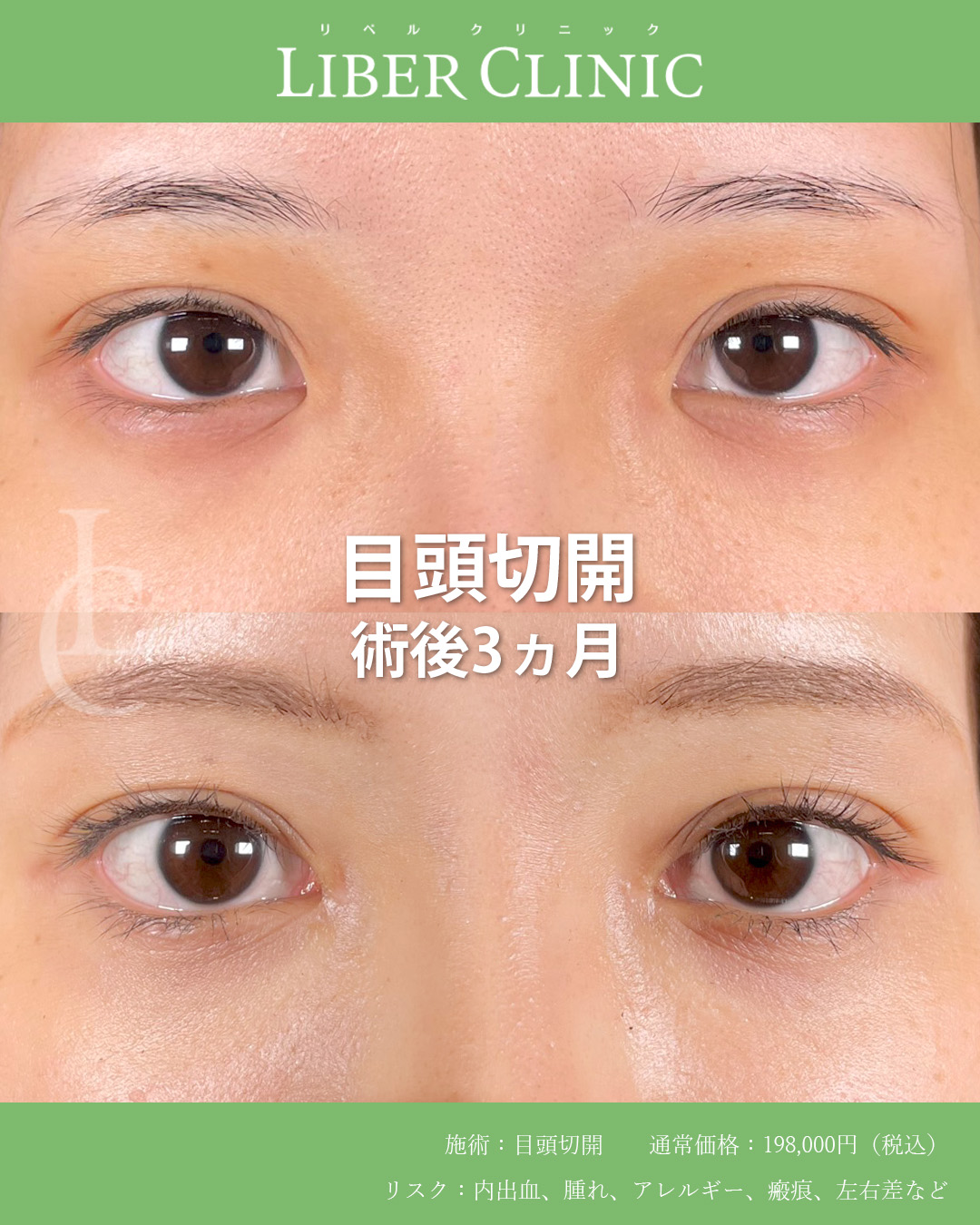 手術前と術後3ヵ月