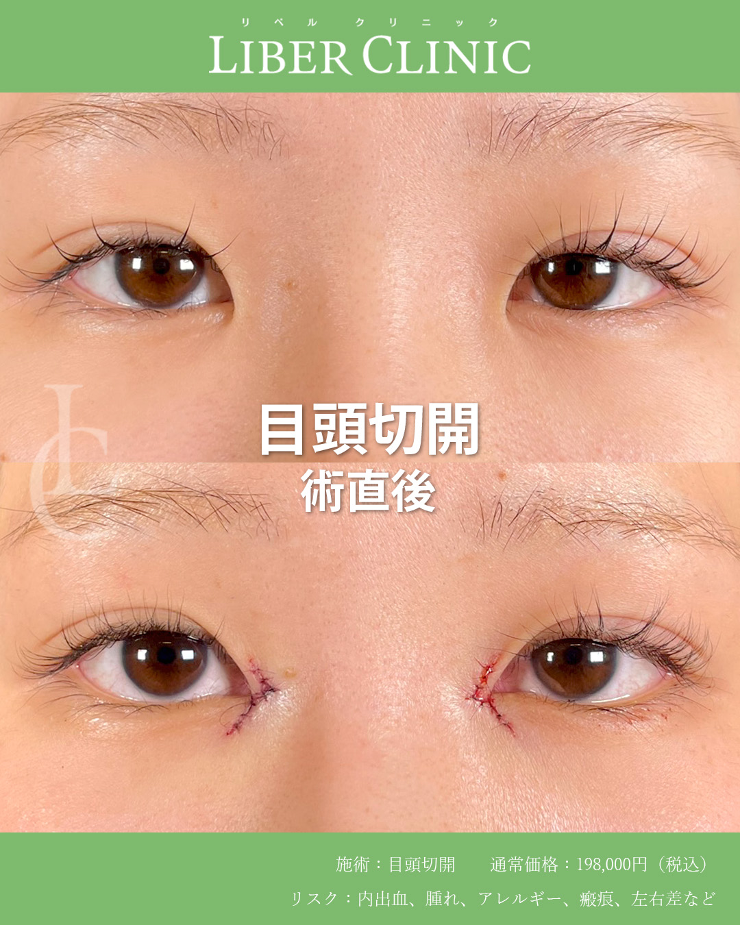 手術前と術直後