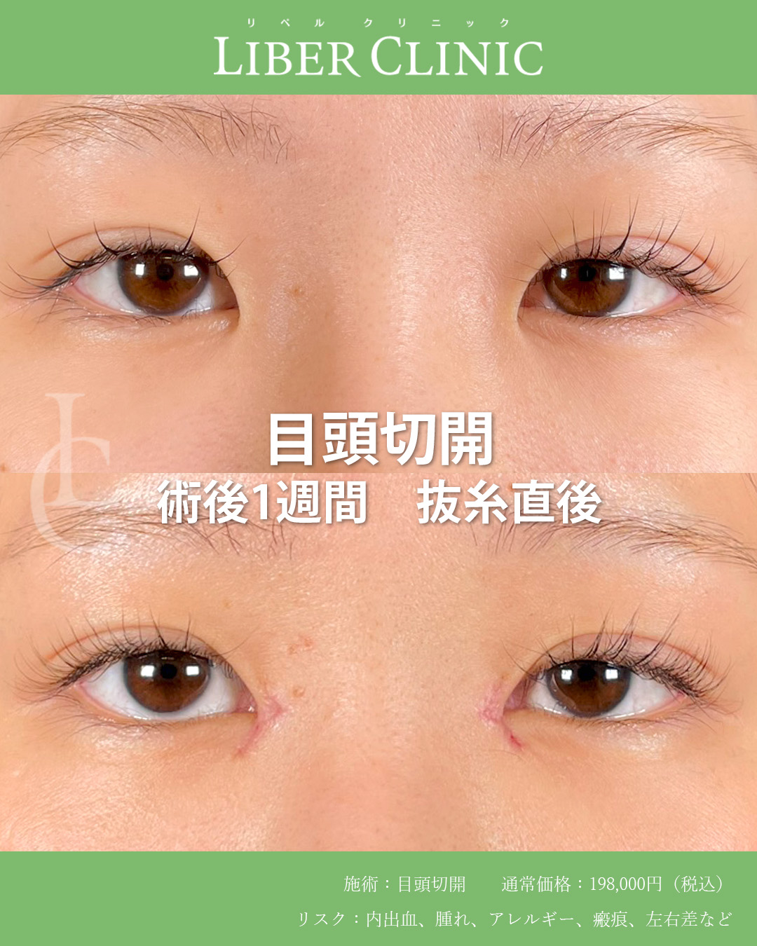 手術前と術後1週間抜糸直後