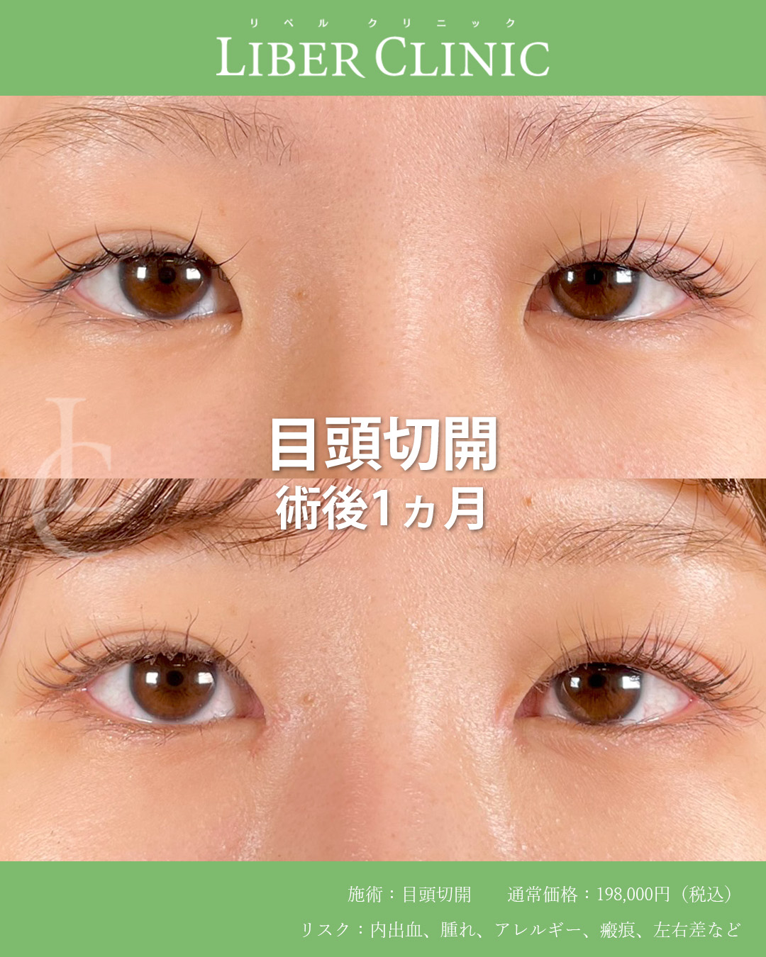 手術前と術後1ヵ月