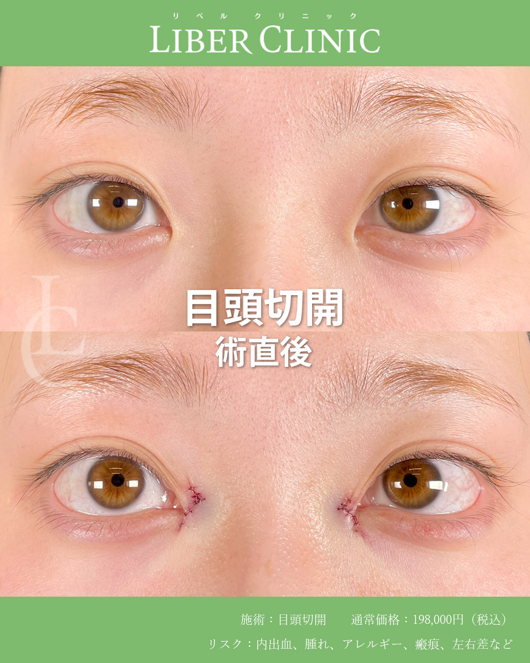 手術前と術直後