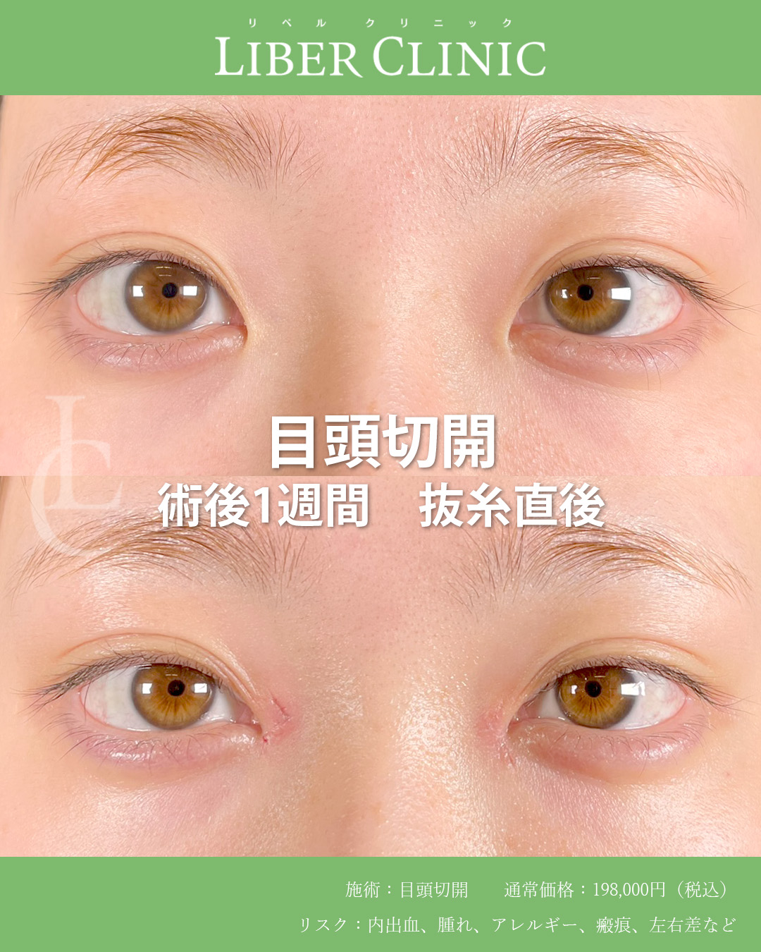 手術前と術後1週間抜糸直後