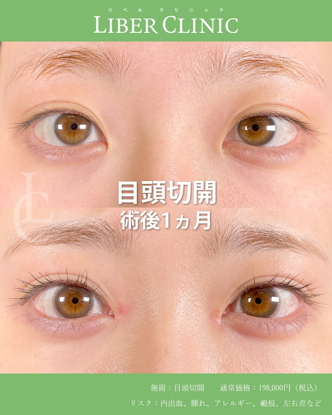 手術前と術後1ヵ月