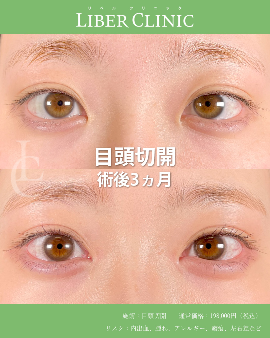 自然だけど変わる目頭切開